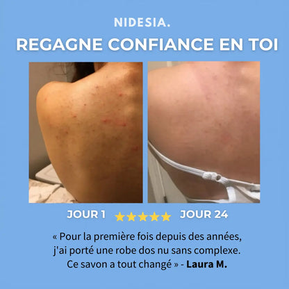 Savon Anti-Acné