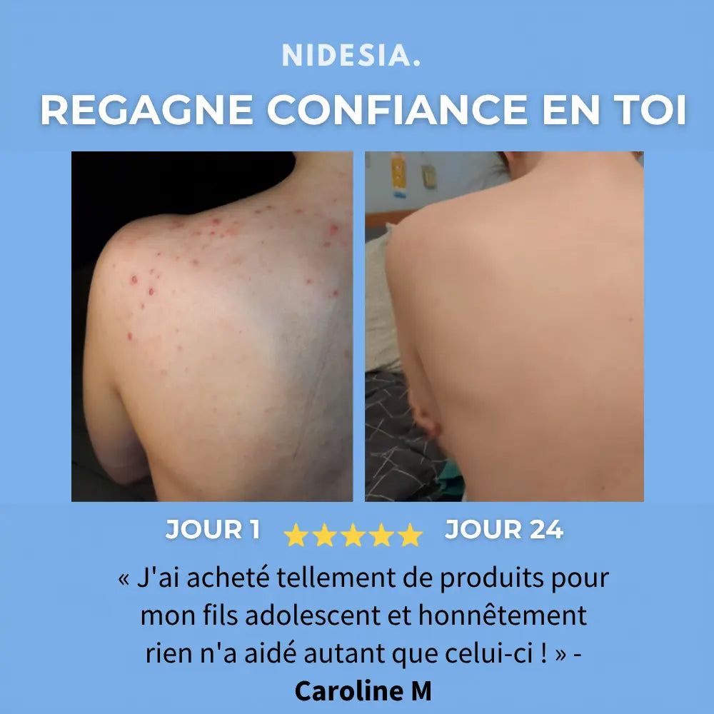 Savon Anti-Acné