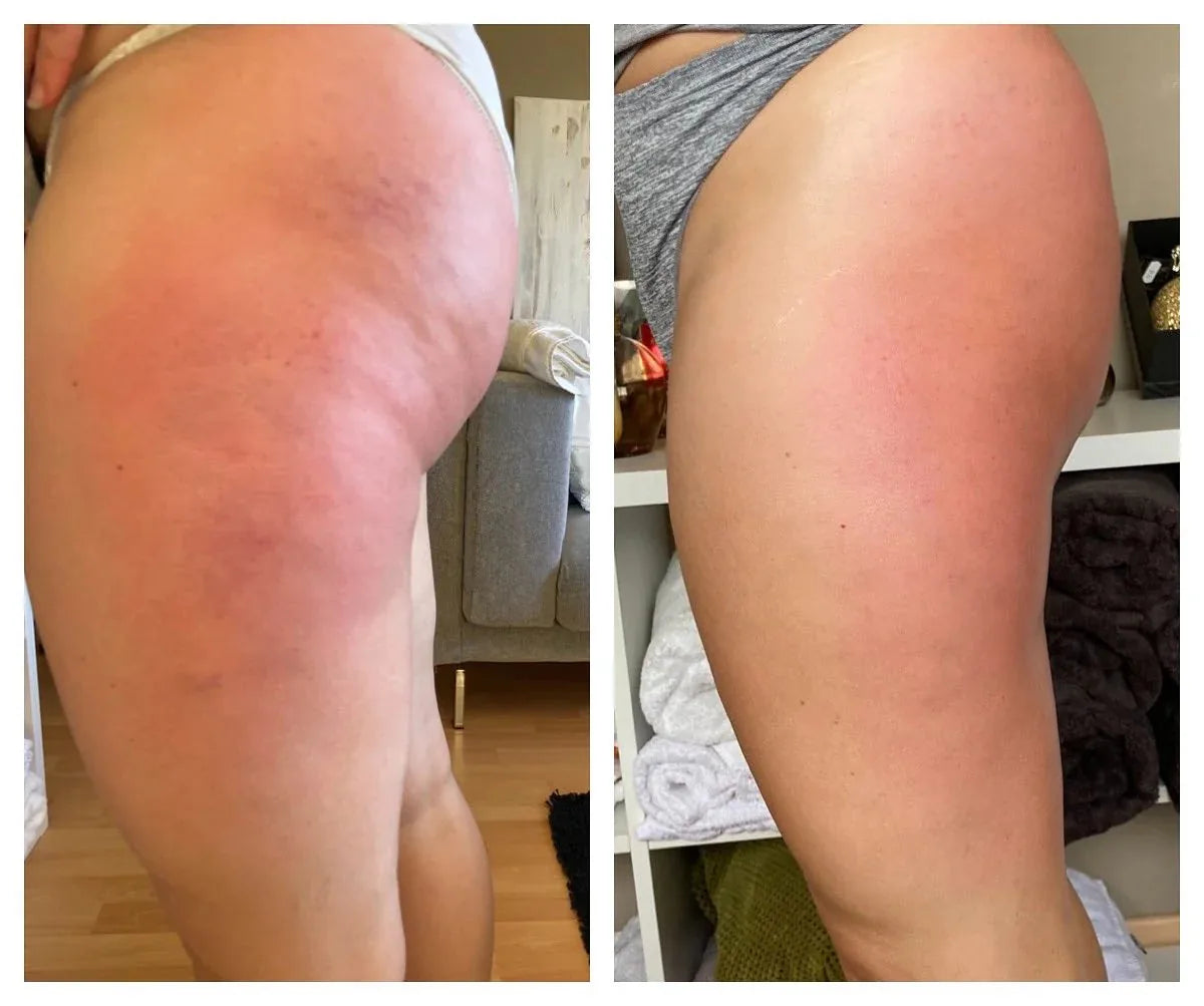 files/celluvia-cellulite-massage-ol-vh1.webp