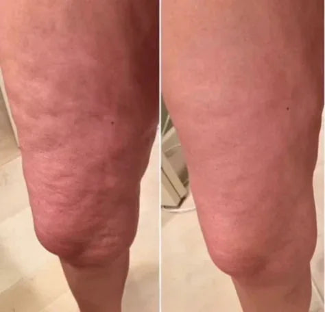 files/celluvia-cellulite-massage-ol-vh2.webp